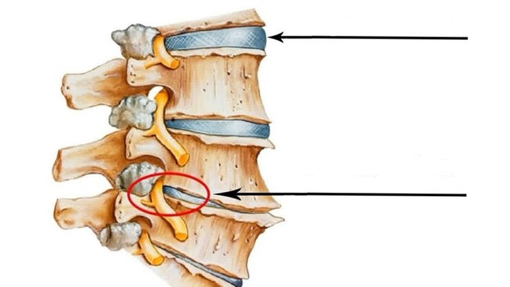 ozljede kralježnice u slučaju cervikalne osteohondroze