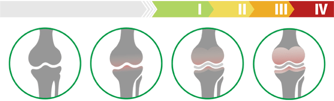 Kliničke faze artroze koljenskog zgloba (stepen artroze koljenskog zgloba)