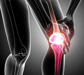 bol u koljenu kod artritisa i artroze