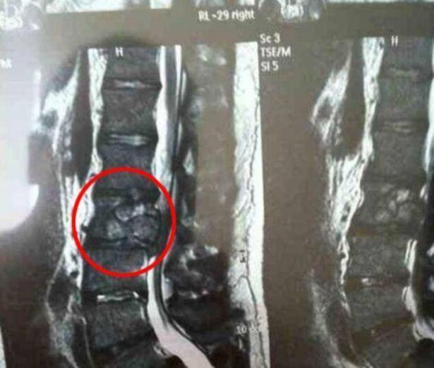 tumor kičme kao uzrok bolova u leđima