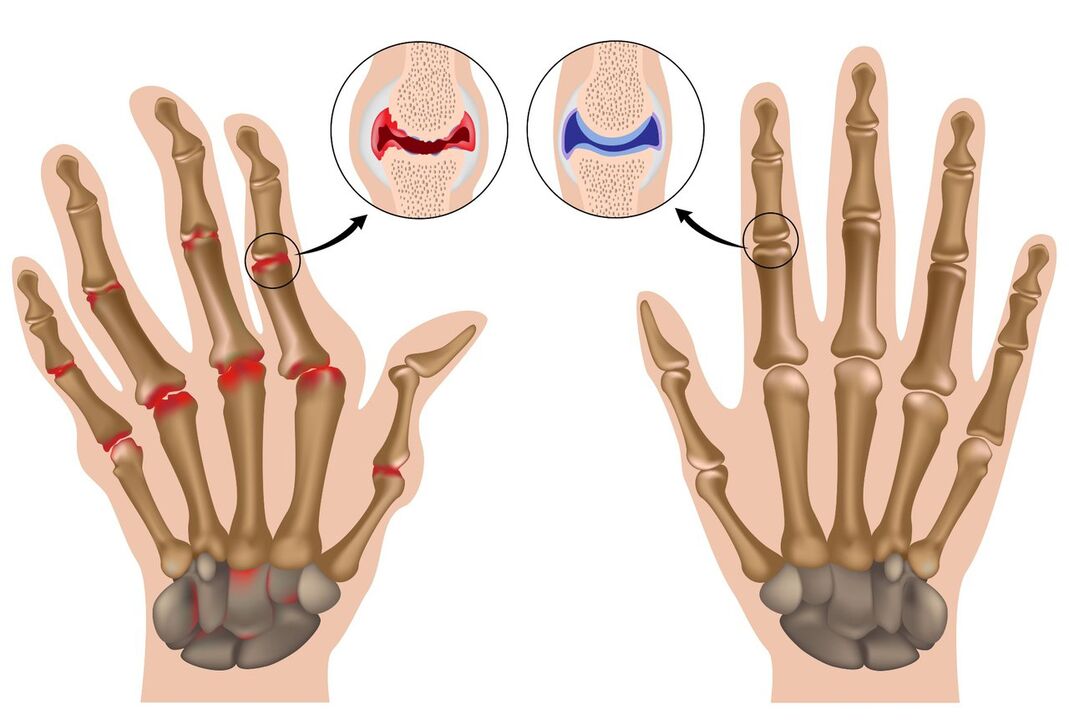 Zdravi i poliartritisom zahvaćeni zglobovi ruku