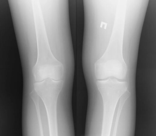 Radiografija zgloba koljena