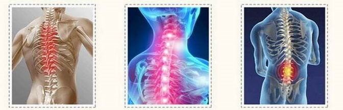 Osteohondrosis Spinal lezije