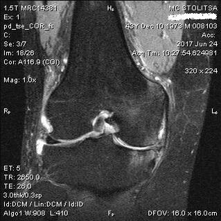 Osteoartritis kolenskog zgloba na MRI